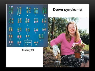 Down syndrome
 
