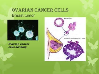 Ovarian cancer cells
Breast tumor

Ovarian cancer
cells dividing

 