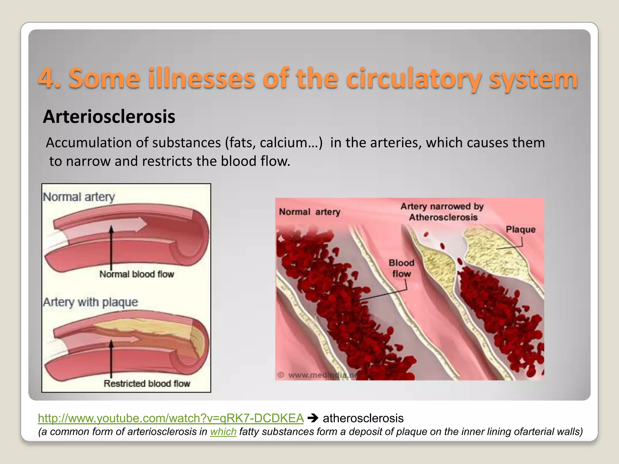 4. Some illnesses of the circulatory system
Arteriosclerosis
Accumulation of substances (fats, calcium…) in the arteries, which causes them
to narrow and restricts the blood flow.

http://www.youtube.com/watch?v=qRK7-DCDKEA  atherosclerosis
(a common form of arteriosclerosis in which fatty substances form a deposit of plaque on the inner lining ofarterial walls)

 