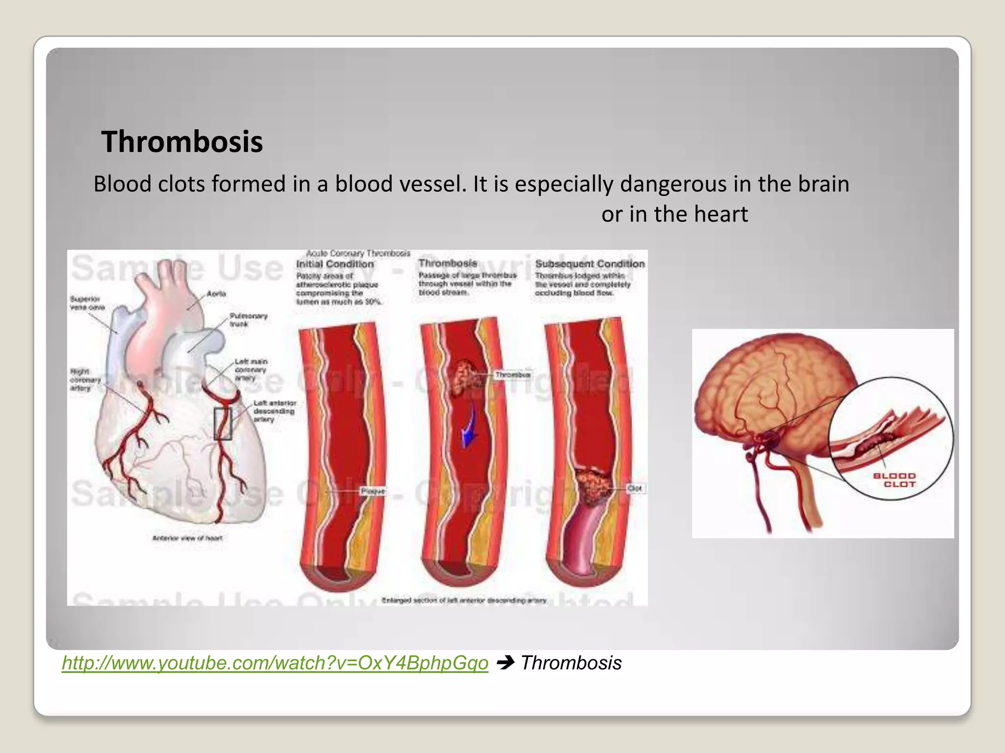 Thrombosis
Blood clots formed in a blood vessel. It is especially dangerous in the brain
or in the heart

http://www.youtube.com/watch?v=OxY4BphpGqo  Thrombosis

 