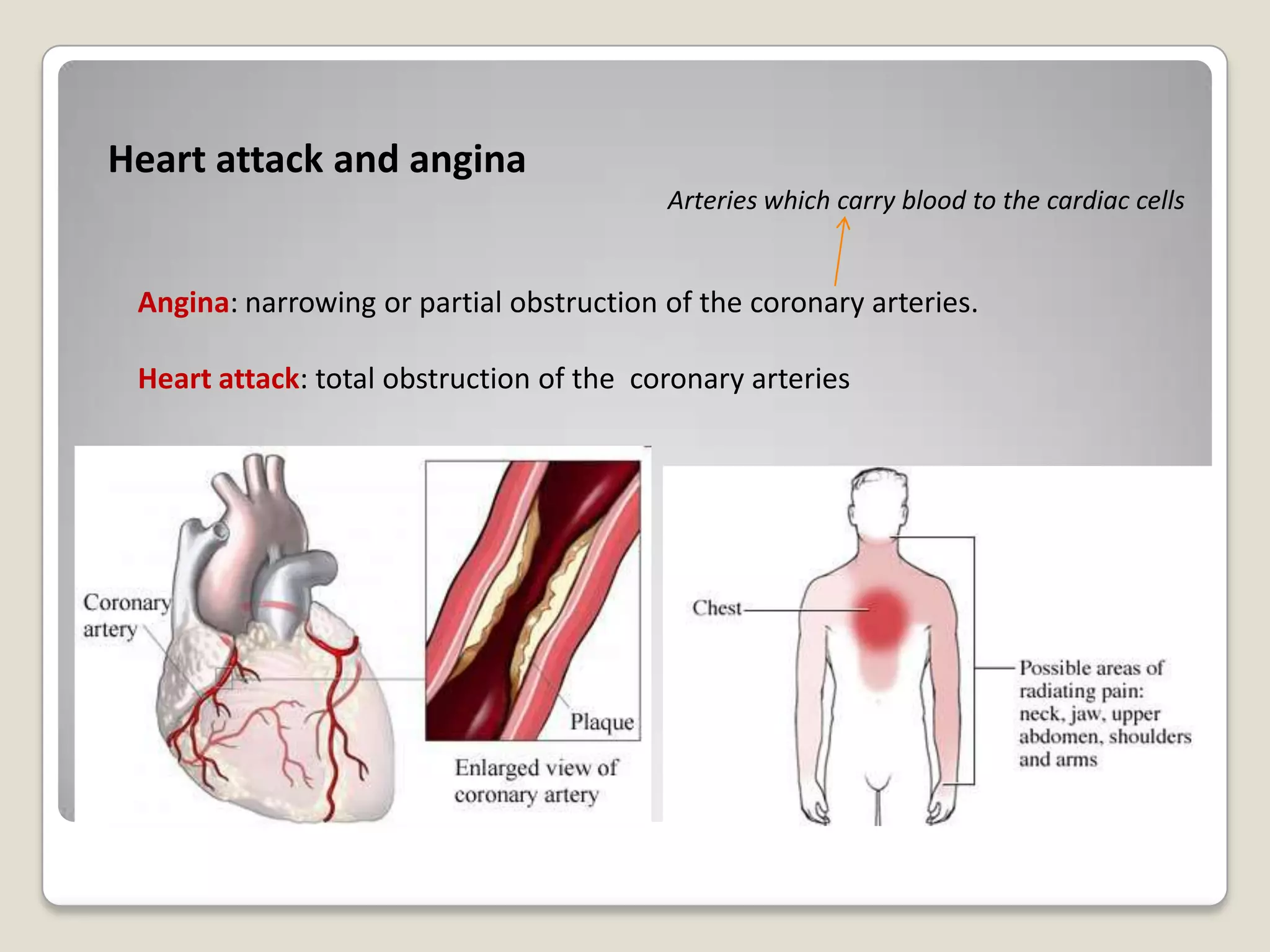Heart attack and angina
Arteries which carry blood to the cardiac cells

Angina: narrowing or partial obstruction of the coronary arteries.
Heart attack: total obstruction of the coronary arteries

 