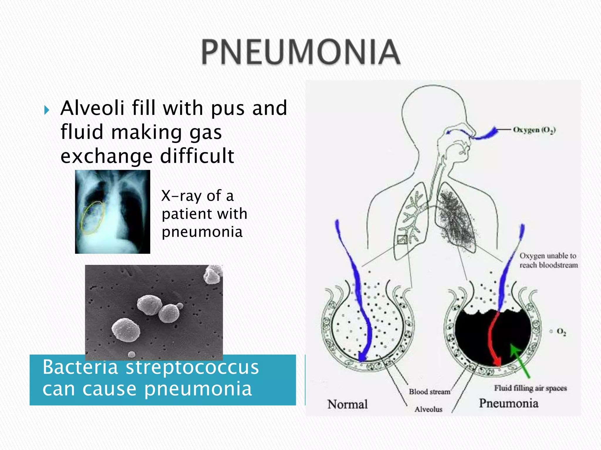    Alveoli fill with pus and
    fluid making gas
    exchange difficult
               X-ray of a
               patient with
               pneumonia




Bacteria streptococcus
can cause pneumonia
 