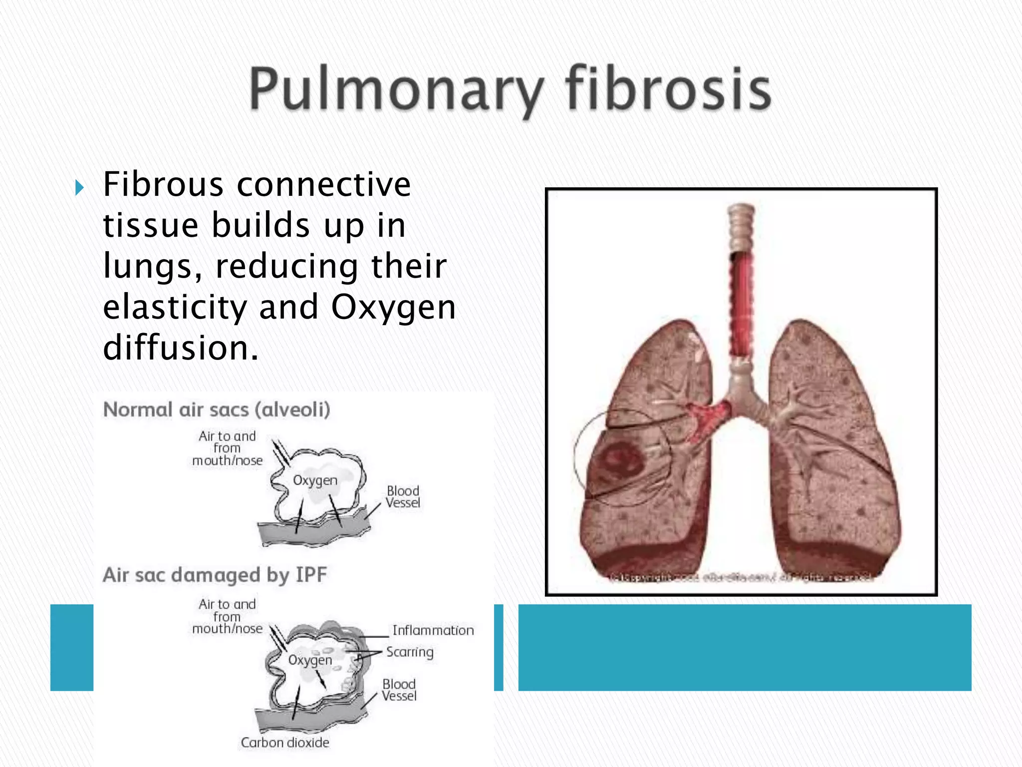    Fibrous connective
    tissue builds up in
    lungs, reducing their
    elasticity and Oxygen
    diffusion.
 