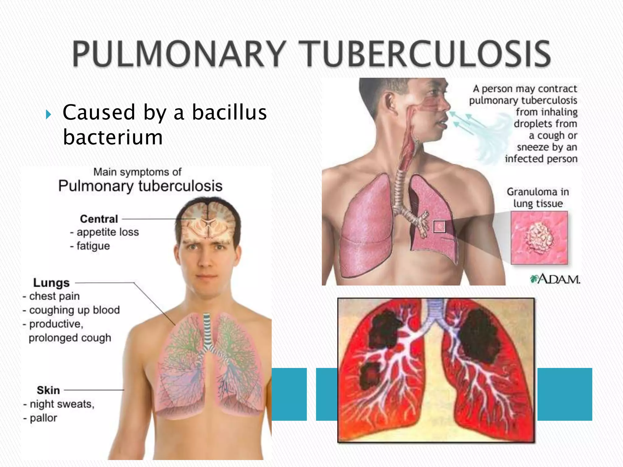    Caused by a bacillus
    bacterium
 