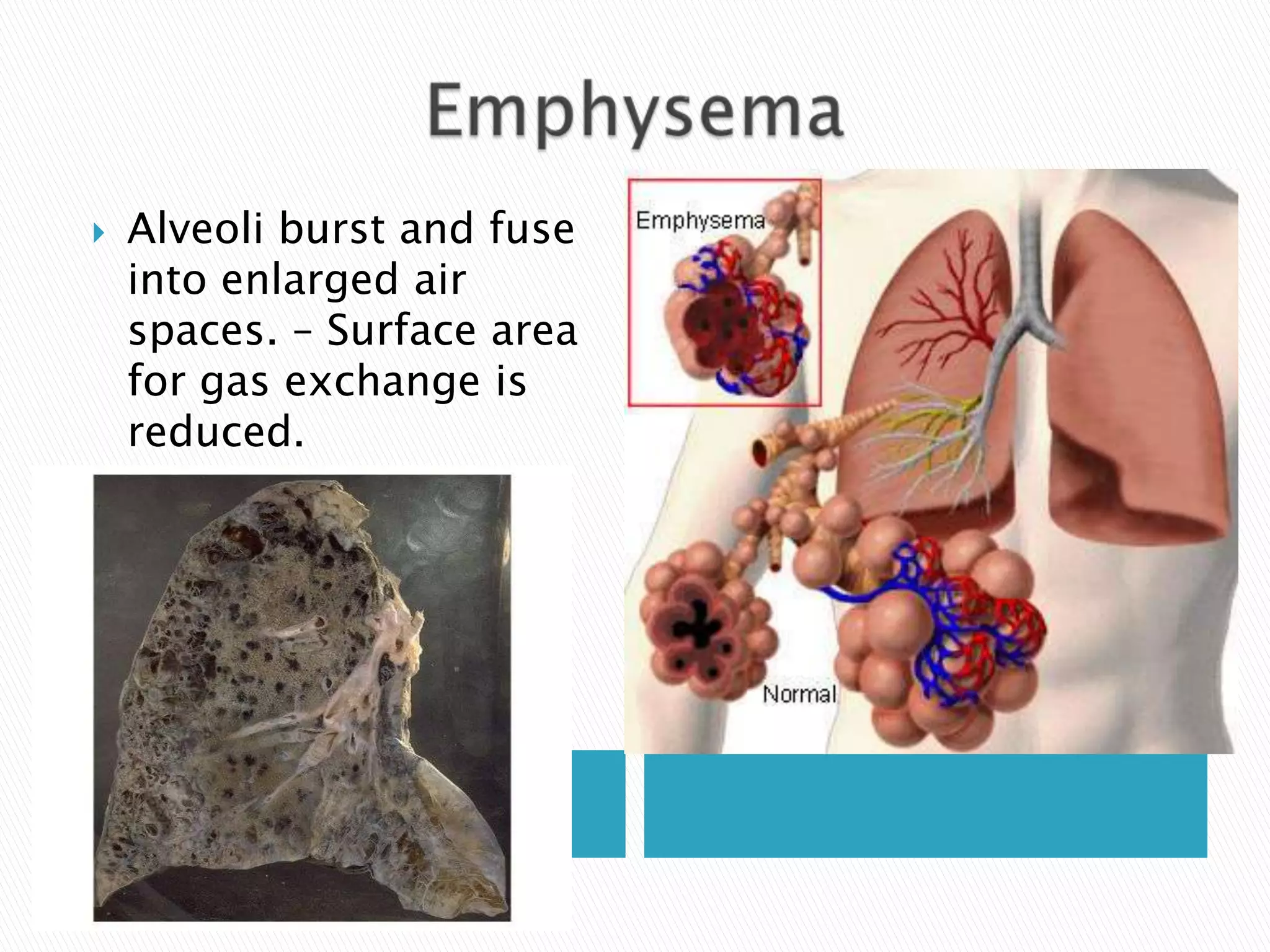    Alveoli burst and fuse
    into enlarged air
    spaces. – Surface area
    for gas exchange is
    reduced.
 