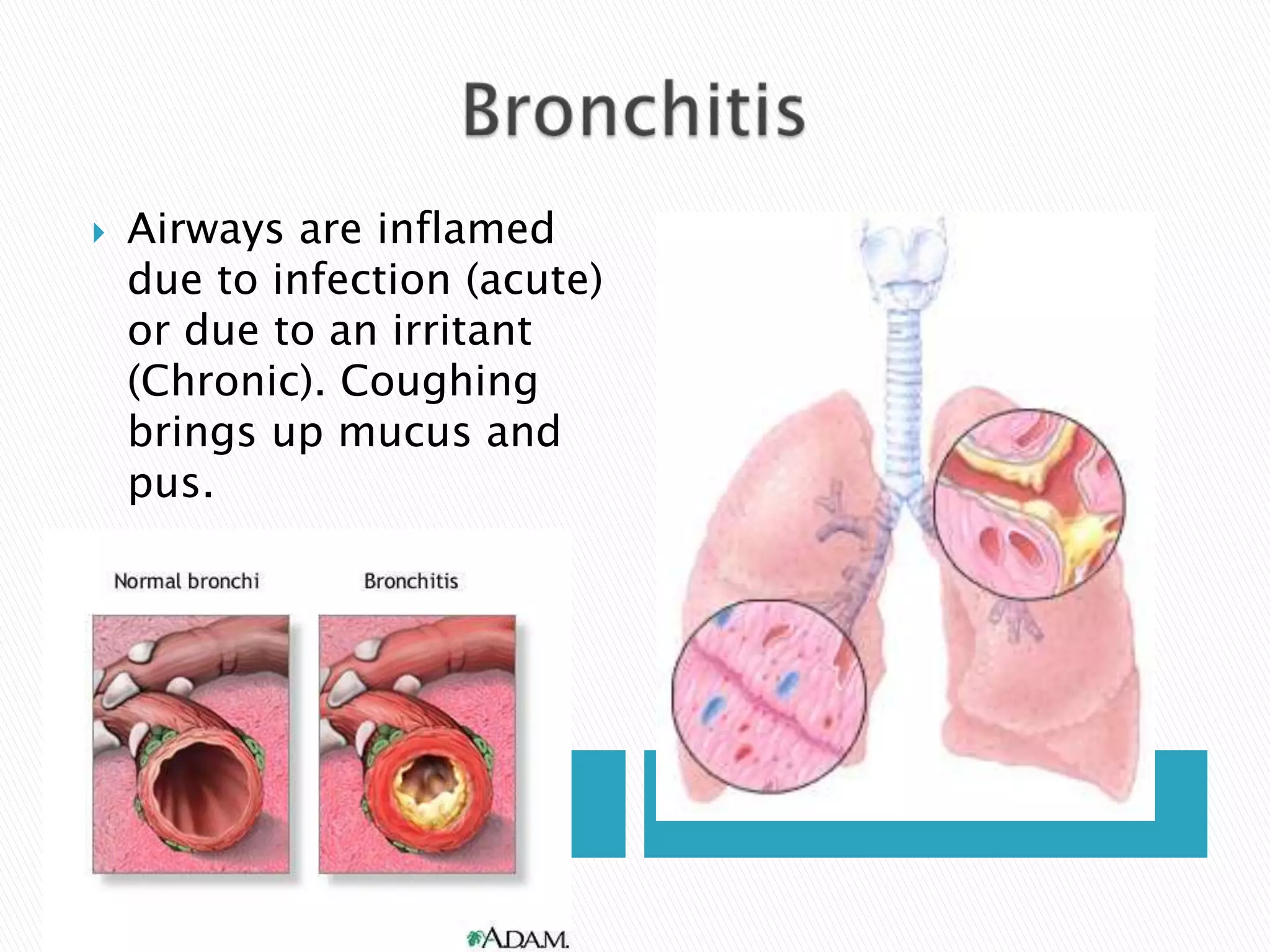    Airways are inflamed
    due to infection (acute)
    or due to an irritant
    (Chronic). Coughing
    brings up mucus and
    pus.
 