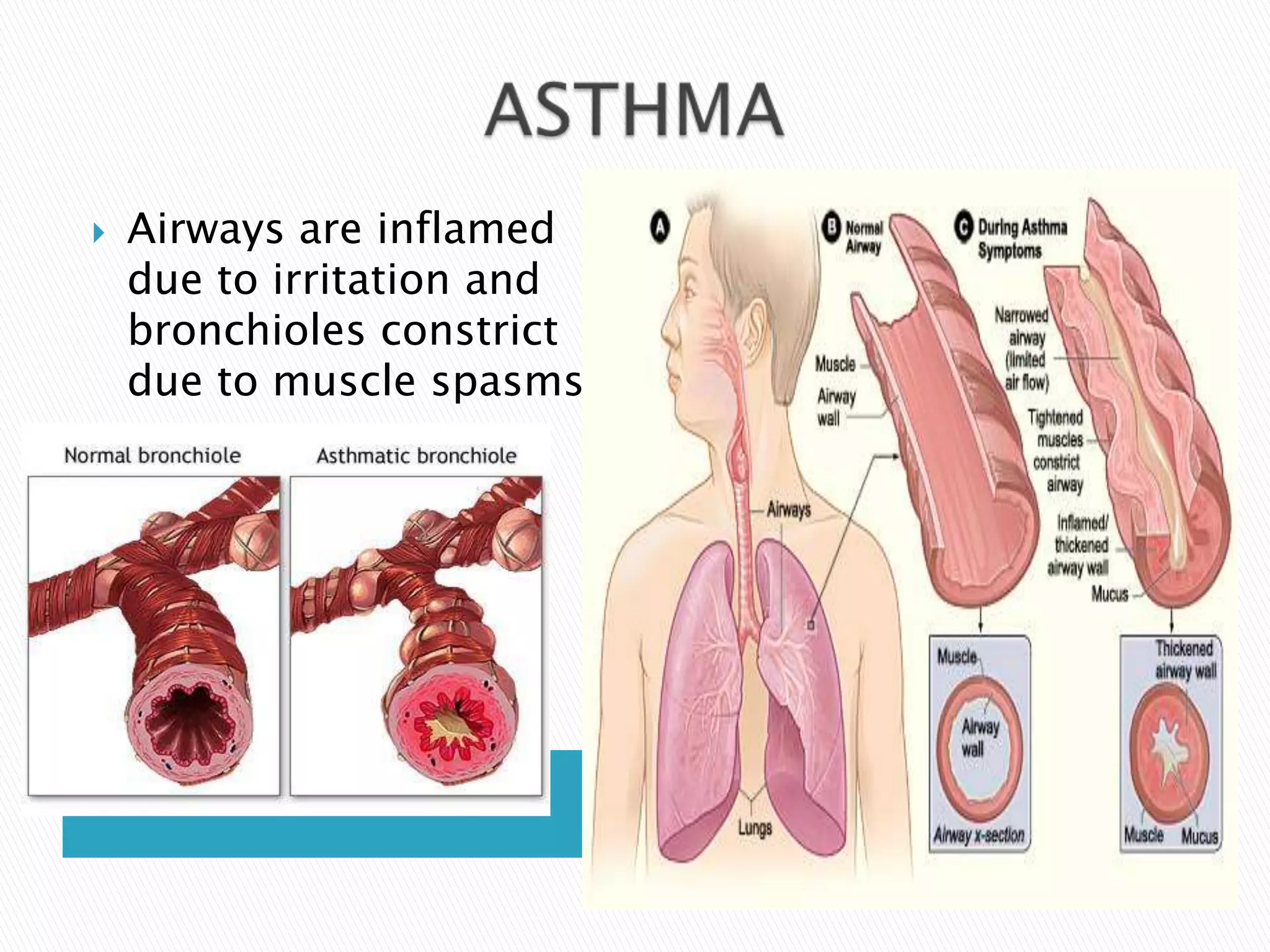    Airways are inflamed
    due to irritation and
    bronchioles constrict
    due to muscle spasms
 