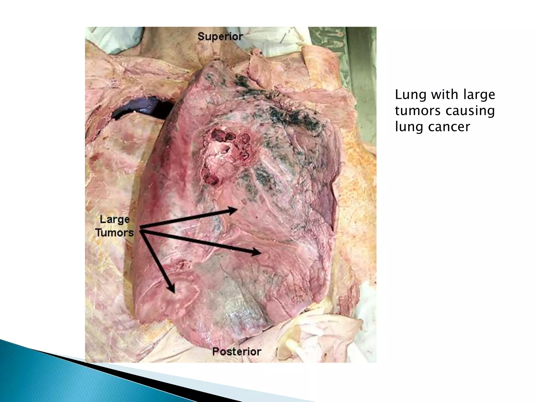 Lung with large
tumors causing
lung cancer
 