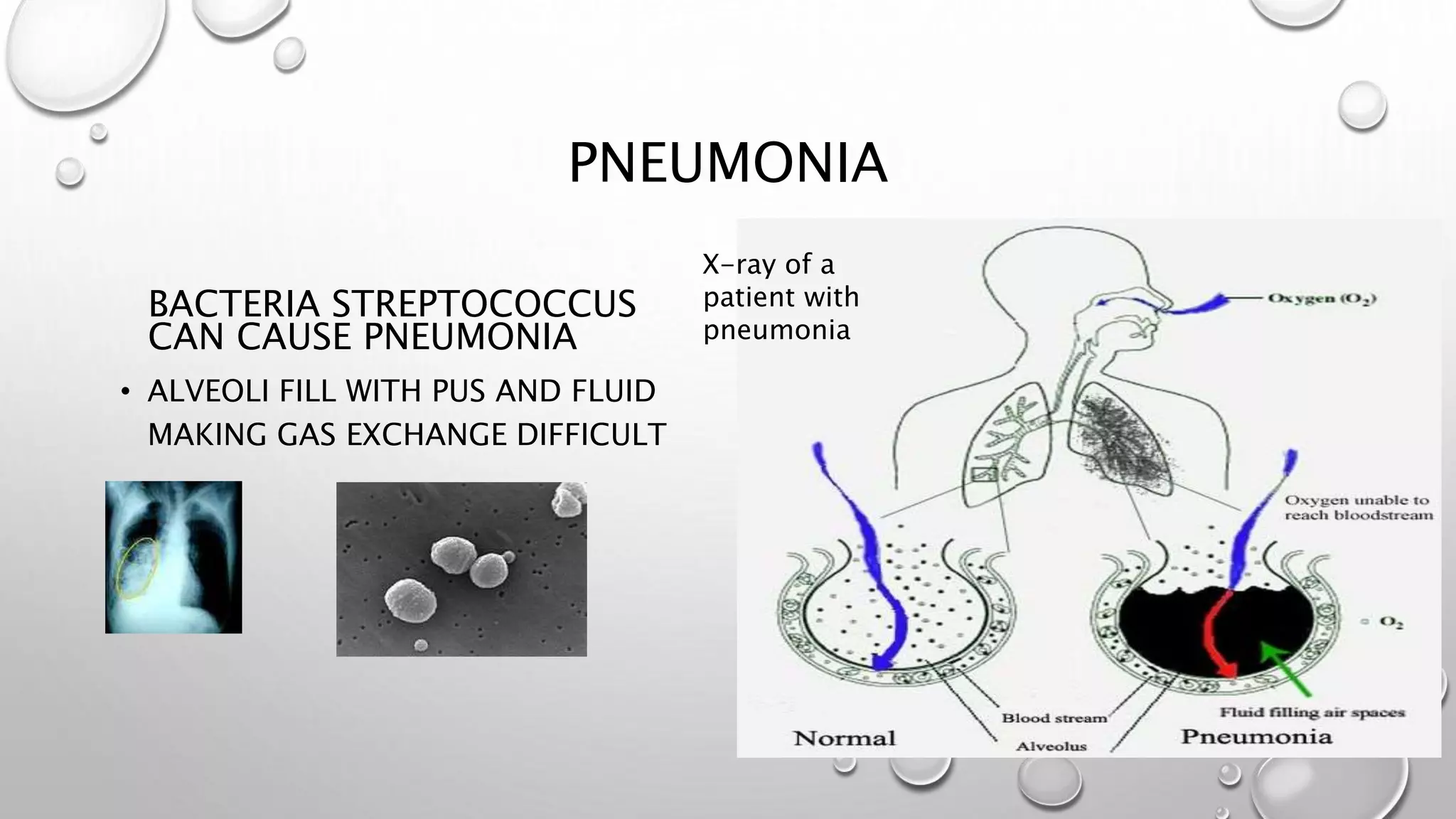 PNEUMONIA
BACTERIA STREPTOCOCCUS
CAN CAUSE PNEUMONIA
• ALVEOLI FILL WITH PUS AND FLUID
MAKING GAS EXCHANGE DIFFICULT
X-ray of a
patient with
pneumonia
 