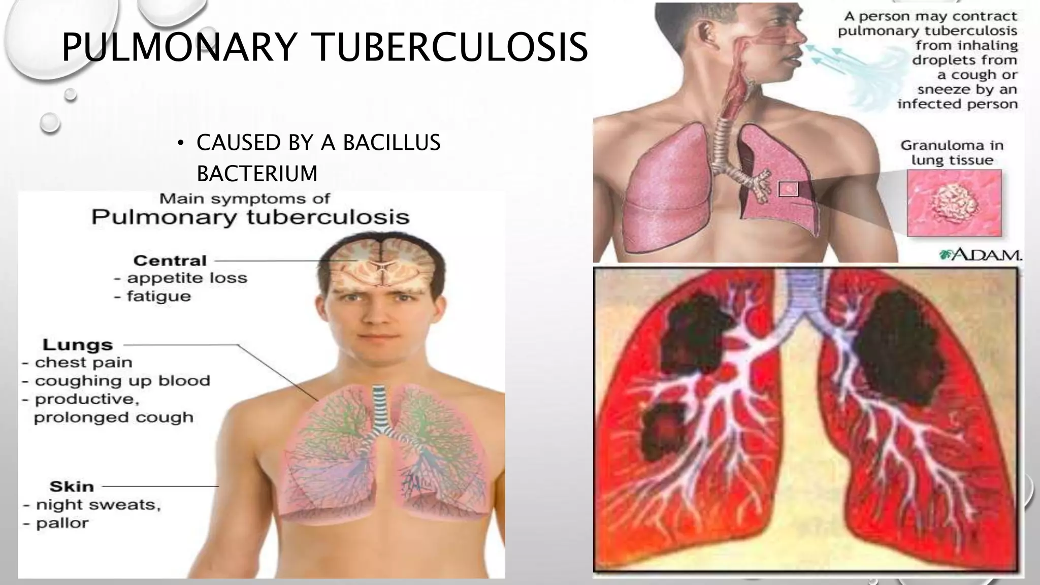 PULMONARY TUBERCULOSIS
• CAUSED BY A BACILLUS
BACTERIUM
 
