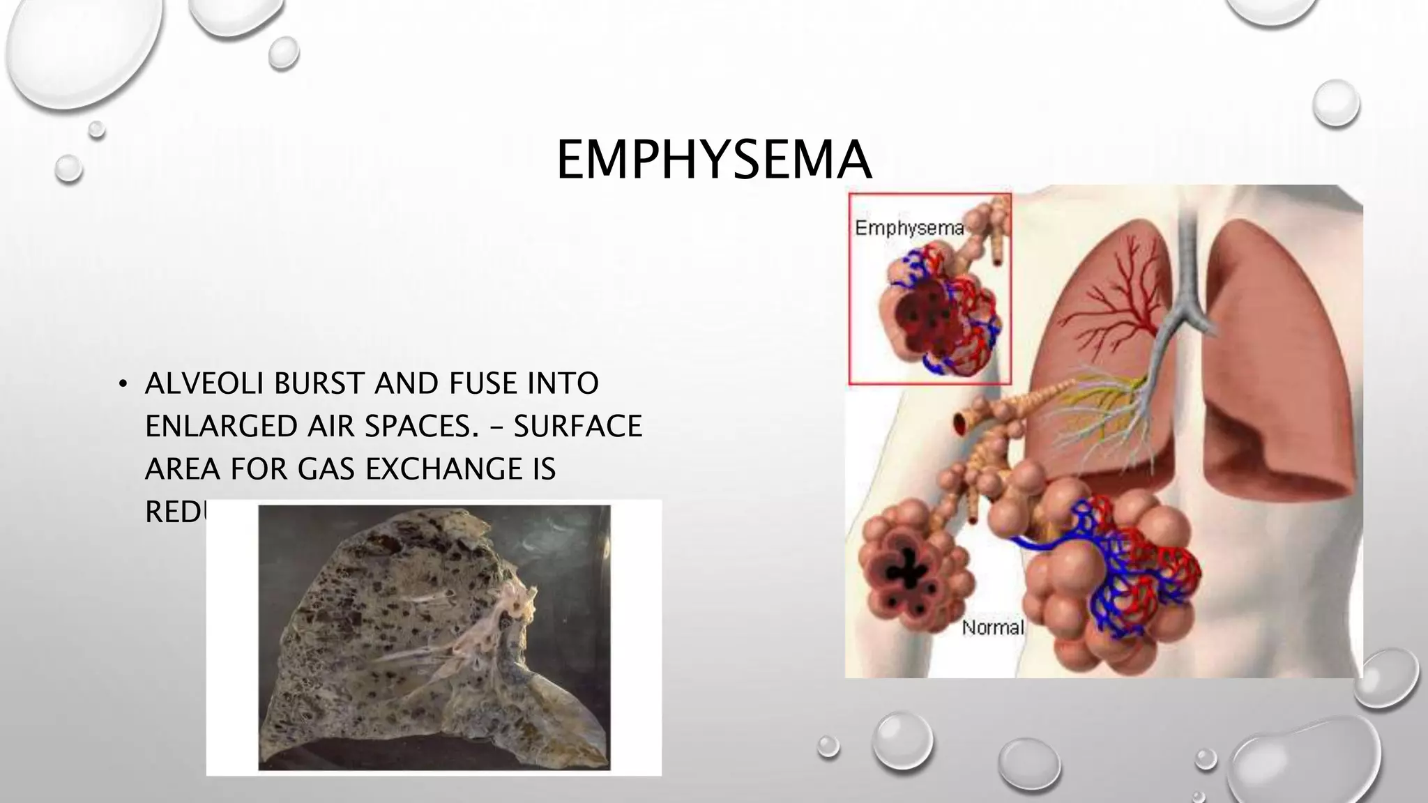 EMPHYSEMA
• ALVEOLI BURST AND FUSE INTO
ENLARGED AIR SPACES. – SURFACE
AREA FOR GAS EXCHANGE IS
REDUCED.
 