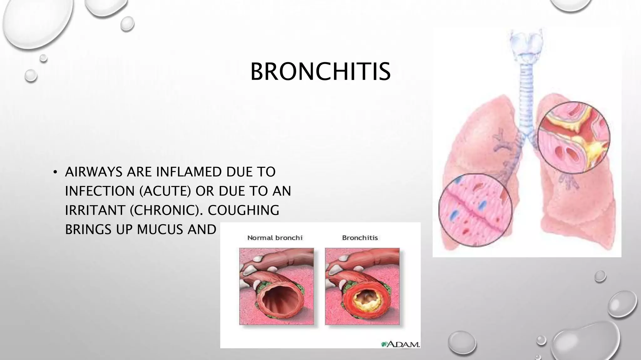 BRONCHITIS
• AIRWAYS ARE INFLAMED DUE TO
INFECTION (ACUTE) OR DUE TO AN
IRRITANT (CHRONIC). COUGHING
BRINGS UP MUCUS AND PUS.
 