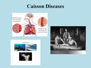Caisson Diseases
 