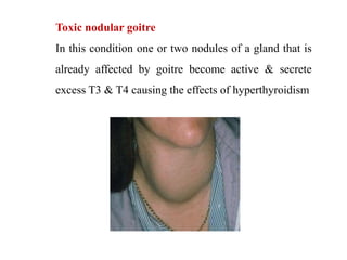 Toxic nodular goitre
In this condition one or two nodules of a gland that is
already affected by goitre become active & secrete
excess T3 & T4 causing the effects of hyperthyroidism
 