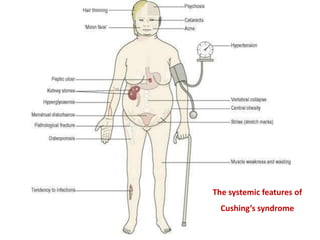 The systemic features of
Cushing’s syndrome
 