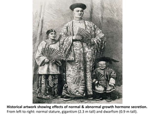 Historical artwork showing effects of normal & abnormal growth hormone secretion.
From left to right: normal stature, gigantism (2.3 m tall) and dwarfism (0.9 m tall).
 