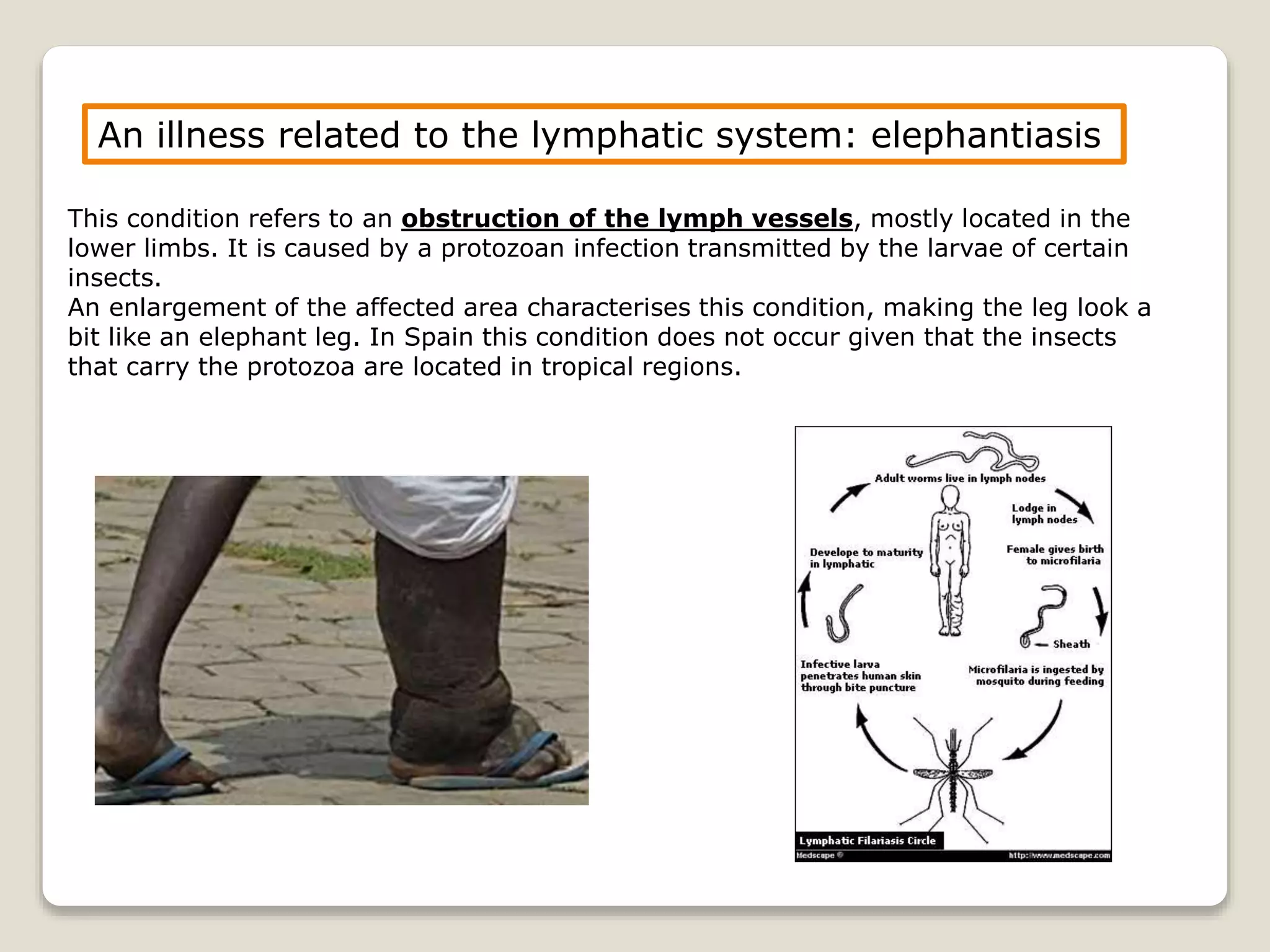 This condition refers to an obstruction of the lymph vessels, mostly located in the
lower limbs. It is caused by a protozoan infection transmitted by the larvae of certain
insects.
An enlargement of the affected area characterises this condition, making the leg look a
bit like an elephant leg. In Spain this condition does not occur given that the insects
that carry the protozoa are located in tropical regions.
An illness related to the lymphatic system: elephantiasis
 