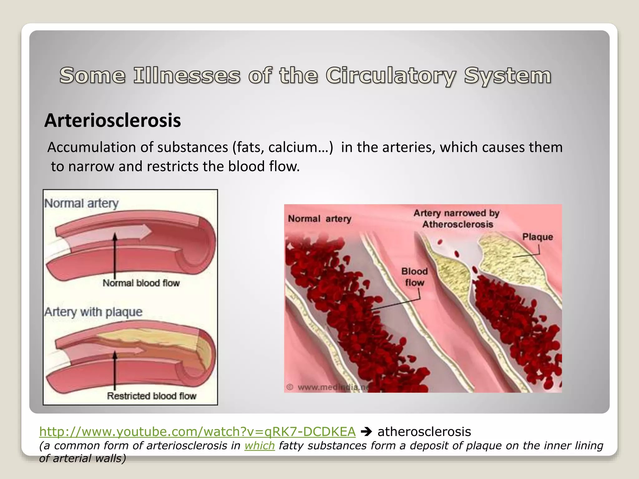 Arteriosclerosis
Accumulation of substances (fats, calcium…) in the arteries, which causes them
to narrow and restricts the blood flow.
http://www.youtube.com/watch?v=qRK7-DCDKEA  atherosclerosis
(a common form of arteriosclerosis in which fatty substances form a deposit of plaque on the inner lining
of arterial walls)
 