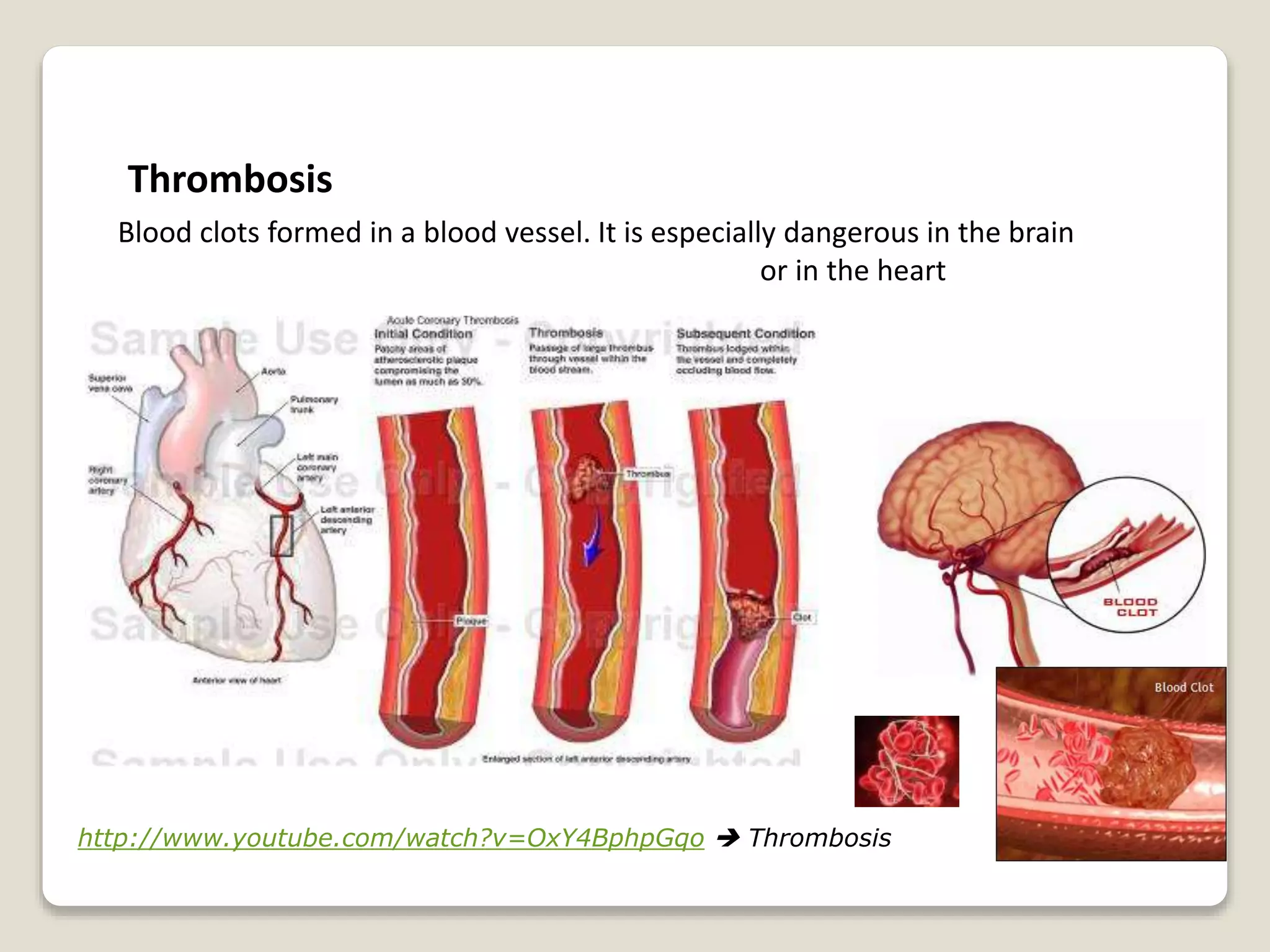 Thrombosis
Blood clots formed in a blood vessel. It is especially dangerous in the brain
or in the heart
http://www.youtube.com/watch?v=OxY4BphpGqo  Thrombosis
 