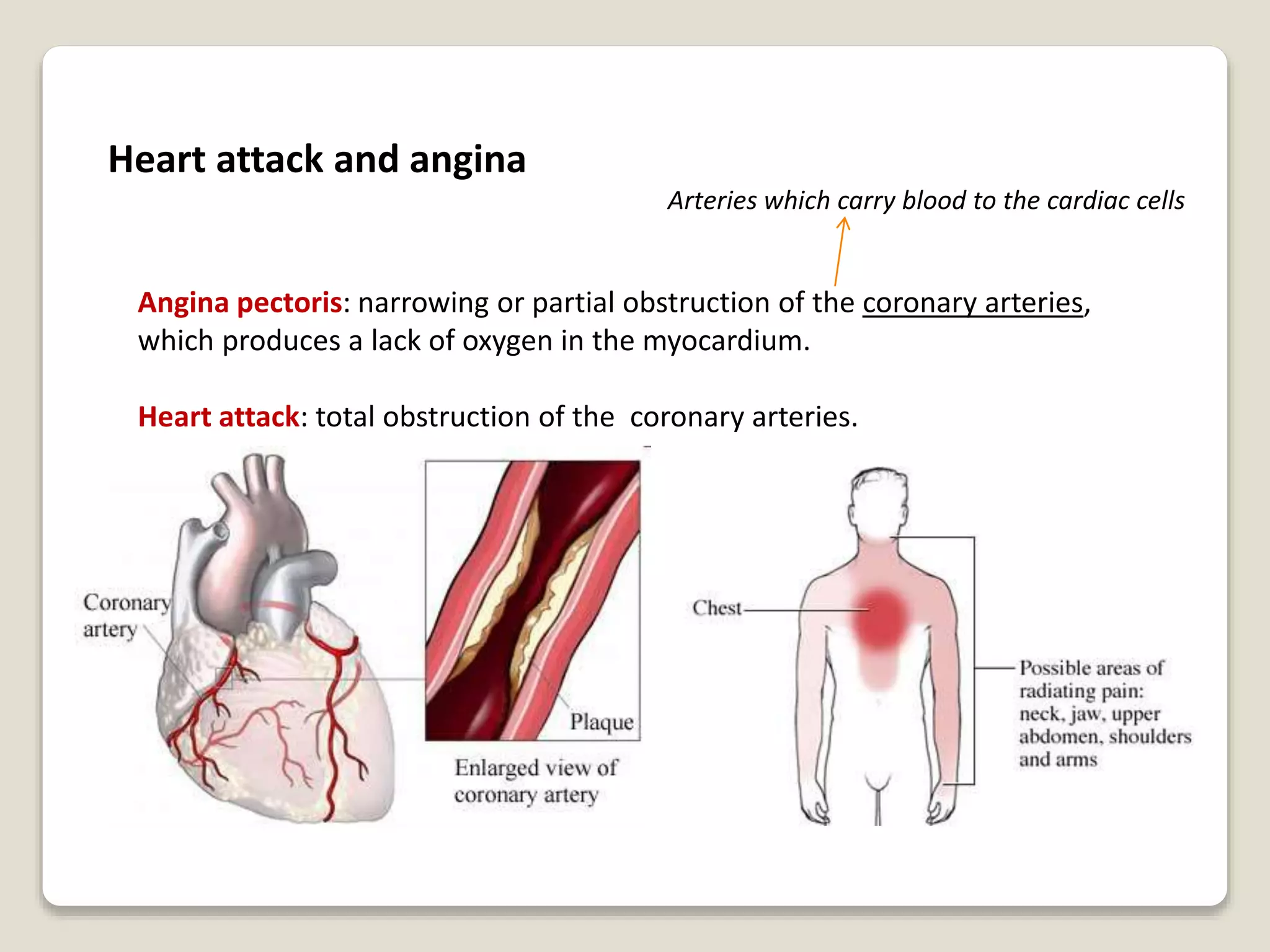 Heart attack and angina
Angina pectoris: narrowing or partial obstruction of the coronary arteries,
which produces a lack of oxygen in the myocardium.
Heart attack: total obstruction of the coronary arteries.
Arteries which carry blood to the cardiac cells
 