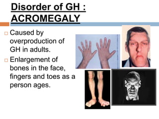 Disorder of GH :
ACROMEGALY
 Caused by
overproduction of
GH in adults.
 Enlargement of
bones in the face,
fingers and toes as a
person ages.
 