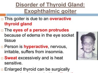 Disorder of Thyroid Gland:
Exophthalmic goiter
 This goiter is due to an overactive
thyroid gland
 The eyes of a person protrudes
because of edema in the eye socket
tissue
 Person is hyperactive, nervous,
irritable, suffers from insomnia.
 Sweat excessively and is heat
sensitive.
 Enlarged thyroid can be surgically
 