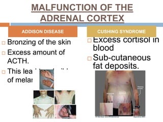 MALFUNCTION OF THE
ADRENAL CORTEX
 Bronzing of the skin
 Excess amount of
ACTH.
 This lead to a buildup
of melanin.
 Excess cortisol in
blood
 Sub-cutaneous
fat deposits.
ADDISON DISEASE CUSHING SYNDROME
 