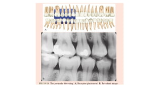 Procedure Bitewing Comprehensive Guide to Bitewing X-Ray Procedure in Dentistry | PPTX