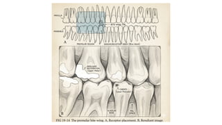 Procedure Bitewing Comprehensive Guide to Bitewing X-Ray Procedure in Dentistry | PPTX