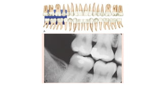 Procedure Bitewing Comprehensive Guide to Bitewing X-Ray Procedure in Dentistry | PPTX