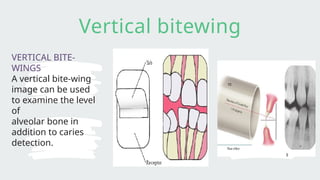 Red Bitewing Comprehensive Guide to Bitewing X-Ray Procedure in Dentistry | PPTX