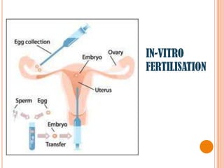 IN-VITRO
FERTILISATION
 