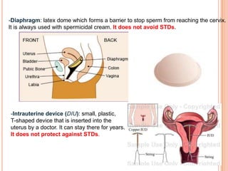 -Diaphragm: latex dome which forms a barrier to stop sperm from reaching the cervix.
It is always used with spermicidal cream. It does not avoid STDs.
-Intrauterine device (DIU): small, plastic,
T-shaped device that is inserted into the
uterus by a doctor. It can stay there for years.
It does not protect against STDs.
 