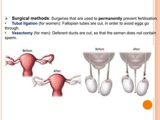  Surgical methods: Surgeries that are used to permanently prevent fertilisation.
• Tubal ligation (for women): Fallopian tubes are cut, in order to avoid eggs go
through.
• Vasectomy (for men): Deferent ducts are cut, so that the semen does not contain
sperm.
 