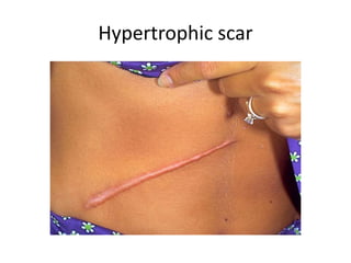 Hypertrophic scar
 
