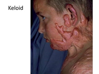 Keloid
 