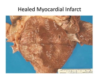 Healed Myocardial Infarct
 