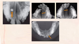 Comprehensive Guide to Occlusal Radiographs in Oral Radiology | PPTX