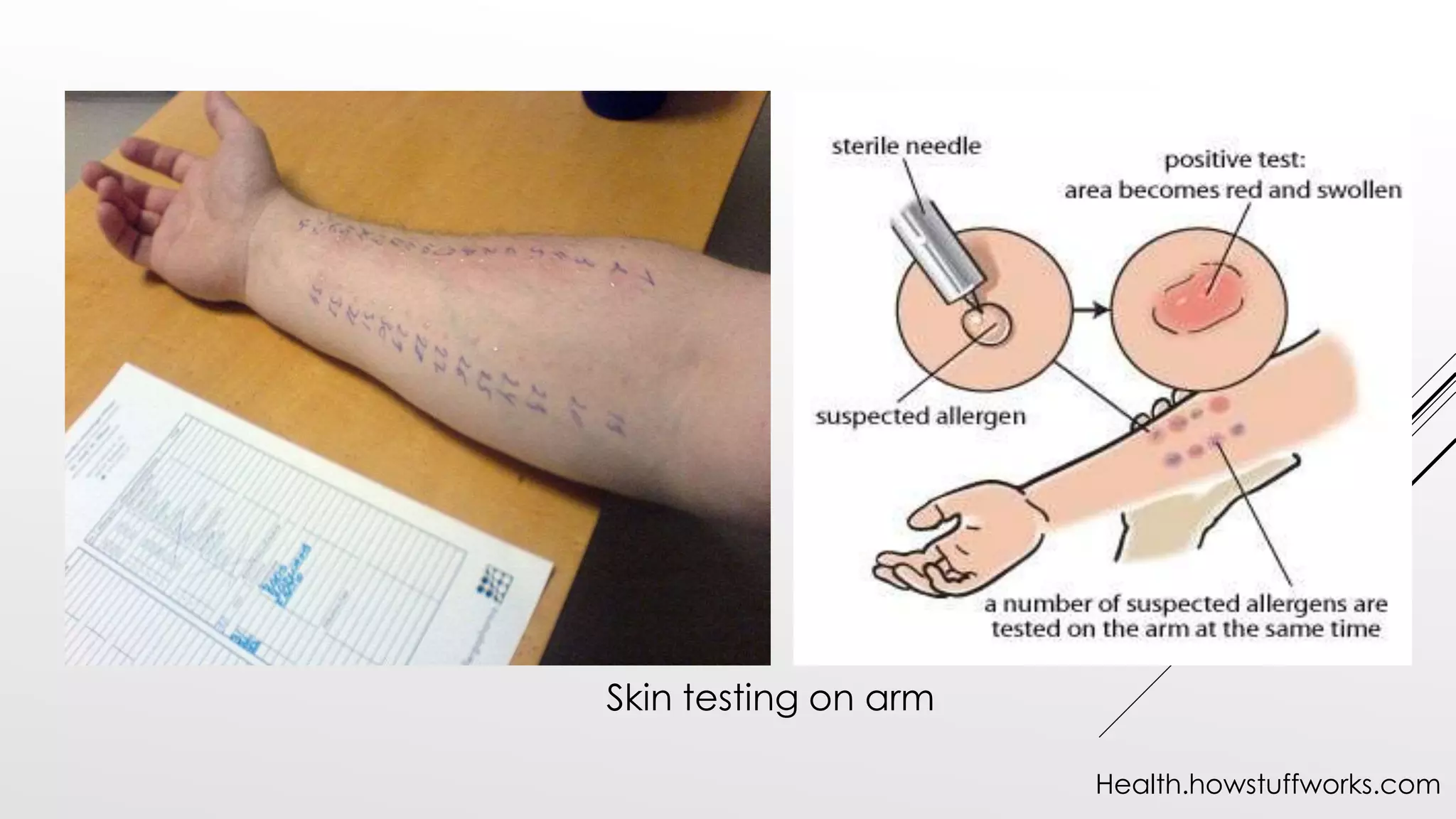 Skin testing on arm
Health.howstuffworks.com
 