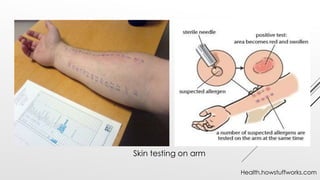 Skin testing on arm
Health.howstuffworks.com
 