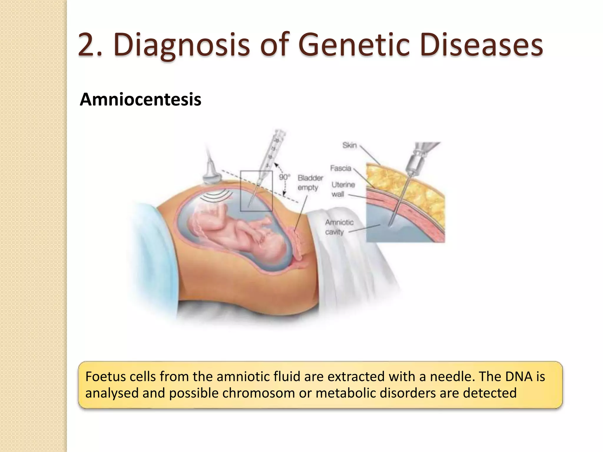 2. Diagnosis of Genetic Diseases
Amniocentesis
Foetus cells from the amniotic fluid are extracted with a needle. The DNA is
analysed and possible chromosom or metabolic disorders are detected
 
