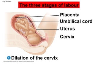 Fig. 46-19-1
Placenta
Umbilical cord
Uterus
Cervix
Dilation of the cervix1
The three stages of labour
 