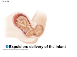 Fig. 46-19-2
Expulsion: delivery of the infant2
 