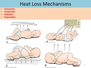 Heat Loss Mechanisms
• Convection
• Conduction
• Radiation
• Evaporation
051104 Neonatal Care 32
 