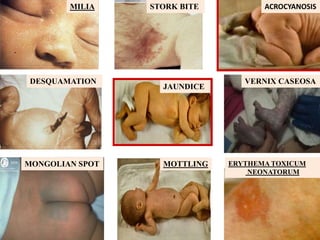 ACROCYANOSIS
DESQUAMATION
MILIA STORK BITE
MONGOLIAN SPOT
VERNIX CASEOSA
JAUNDICE
MOTTLING ERYTHEMA TOXICUM
NEONATORUM
 