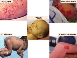 PORT WINE STAIN
STRAWBERRY MARKS
ECCHYMOSES
PETECHIAE
PALLOR
 