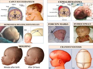 CAPUT SUCCEEDANEUM
MOLDING
FORCEPS MARKS
DEPRESSED & BULGING FONTANELLES HYDROCEPHALY
CEPHALHEMATOMA
CRANIOSYNOSTOSIS
 