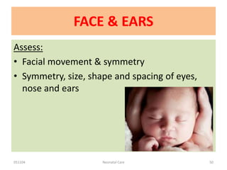 051104 Neonatal Care 50
FACE & EARS
Assess:
• Facial movement & symmetry
• Symmetry, size, shape and spacing of eyes,
nose and ears
 