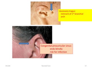 051104 Neonatal Care 57
Accessory tragus:
remnant of 1st branchial
arch
Congenital preauricular sinus:
ends blindly
risk for infection
 
