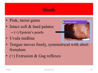 051104 Neonatal Care 58
Mouth
• Pink, moist gums
• Intact soft & hard palates
– (+) Epstein’s pearls
• Uvula midline
• Tongue moves freely, symmetrical with short
frenulum
• (+) Extrusion & Gag reflexes
 